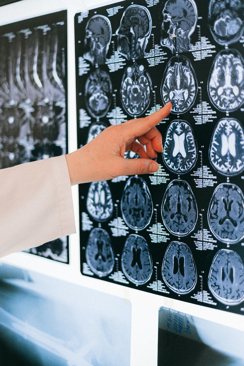 La nouvelle technique d’IRM de l’Université permet de prédire les maladies cérébrales