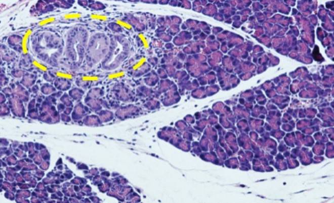 Des bactéries buccales accélèrent le développement du cancer du pancréas chez les souris : Une recherche de l’Université révèle des découvertes clés