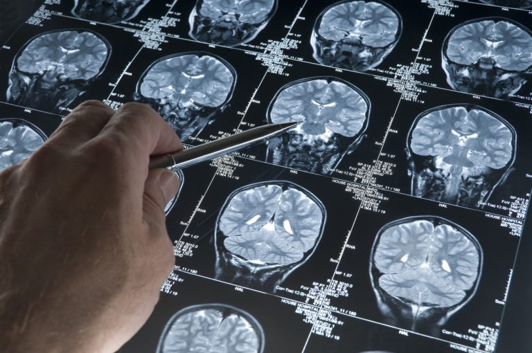 De nouvelles découvertes révèlent comment le virus Herpès Simplex de type 1 influence la progression de la maladie d’Alzheimer